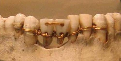 Ancient Egyptian version of braces.